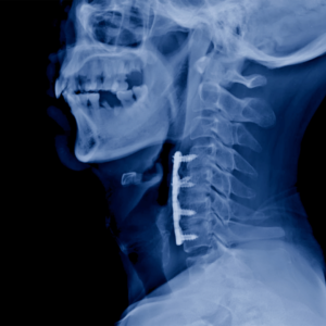 Cirurgia ACDF Explicada: Alívio para Dor no Pescoço e Problemas na Coluna